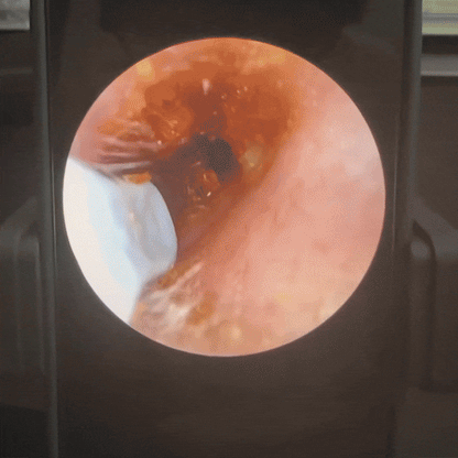 AuriClear™️ Earwax Remover